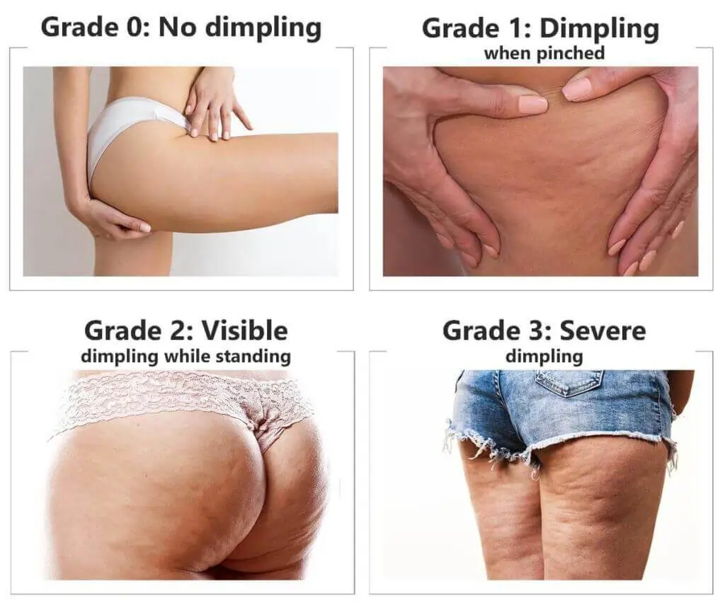 Representation of the stages of cellulite development Rainham